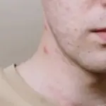 Jerawat di Leher Tiba-tiba Muncul di Usia 40, Ini Sebabnya