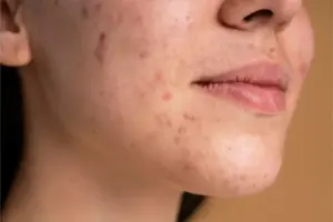 Apa Itu Jerawat Hormon? Ini Penyebab dan Ciri-cirinya